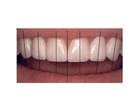 歯の角度