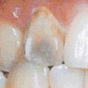 虫歯で変色した歯