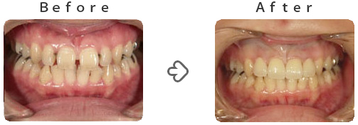 前歯のすき間をセラミックで治しました。